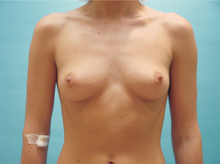 Photo of Patient 08 Before Breast Augmentation
