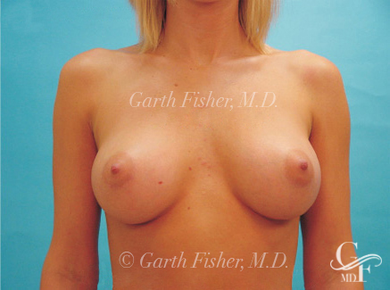 Photo of Patient 08 After Breast Augmentation