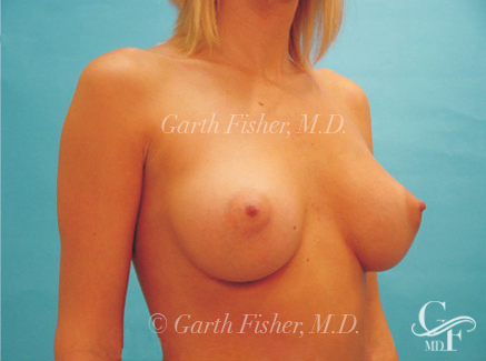 Photo of Patient 08 After Breast Augmentation