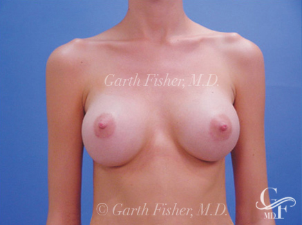 Photo of Patient 10 After Breast Augmentation