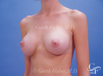 Photo of Patient 10 After Breast Augmentation