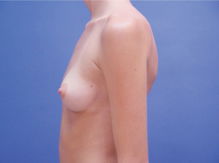 Photo of Patient 10 Before Breast Augmentation