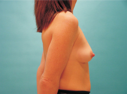 Photo of Patient 11 Before Breast Augmentation