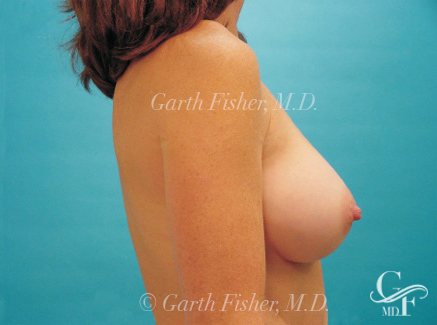 Photo of Patient 11 After Breast Augmentation