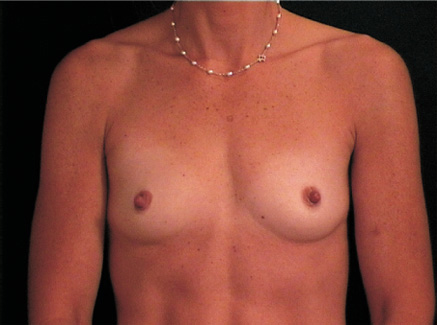 Photo of Patient 12 Before Breast Augmentation