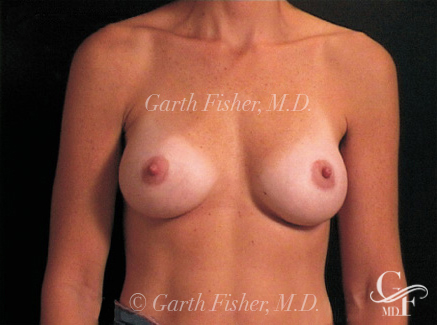 Photo of Patient 12 After Breast Augmentation