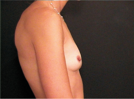 Photo of Patient 12 Before Breast Augmentation