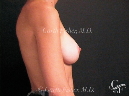 Photo of Patient 12 After Breast Augmentation