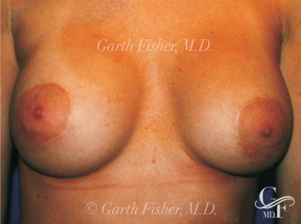 Photo of Patient 02 After Breast Lift