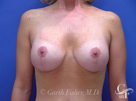 Photo of Patient 03 After Breast Lift