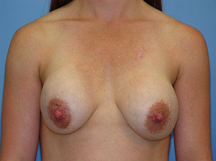 Photo of Patient 04 Before Breast Lift