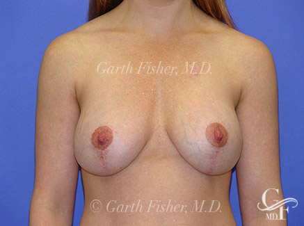 Photo of Patient 04 After Breast Lift