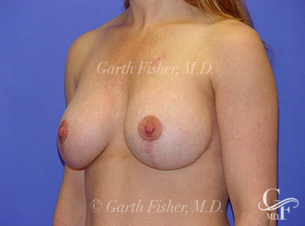 Photo of Patient 04 After Breast Lift