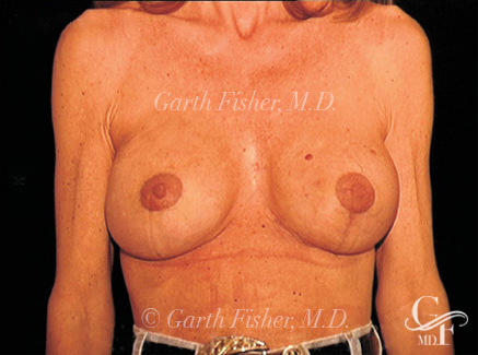 Photo of Patient 06 After Breast Lift