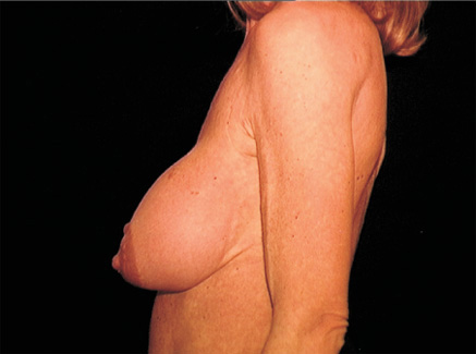 Photo of Patient 06 Before Breast Lift
