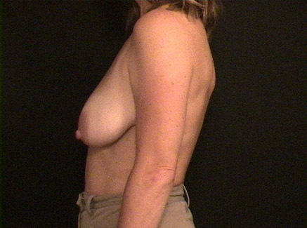 Photo of Patient 07 Before Breast Lift