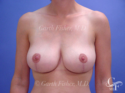 Photo of Patient 08 After Breast Lift
