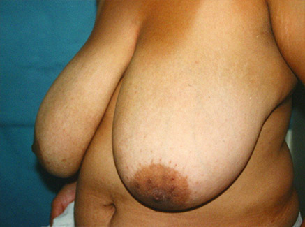 Photo of Patient 09 Before Breast Lift