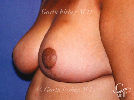 Photo of Patient 09 After Breast Lift
