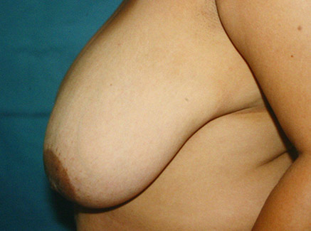 Photo of Patient 09 Before Breast Lift
