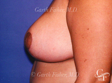 Photo of Patient 09 After Breast Lift