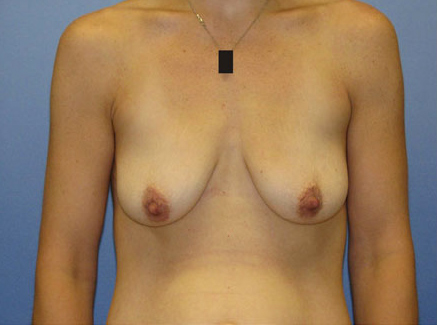 Photo of Patient 10 Before Breast Lift