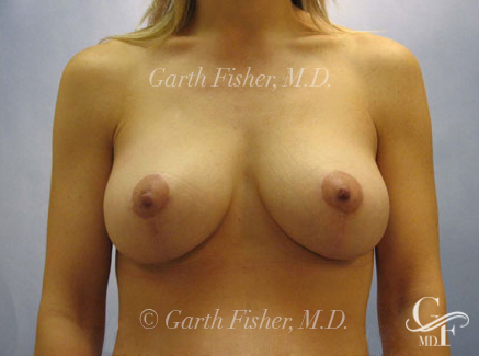Photo of Patient 10 After Breast Lift