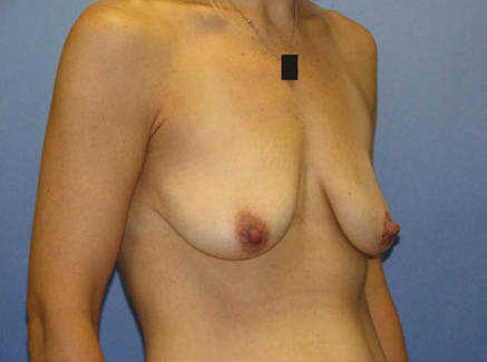 Photo of Patient 10 Before Breast Lift