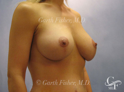 Photo of Patient 10 After Breast Lift