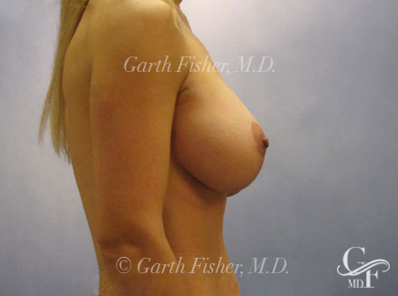 Photo of Patient 10 After Breast Lift