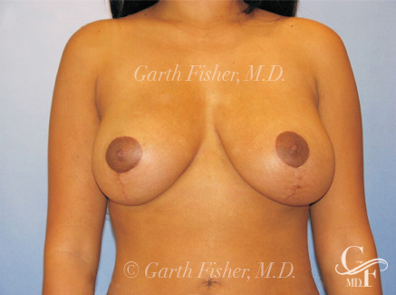 Photo of Patient 11 After Breast Lift