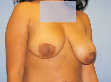 Photo of Patient 11 Before Breast Lift