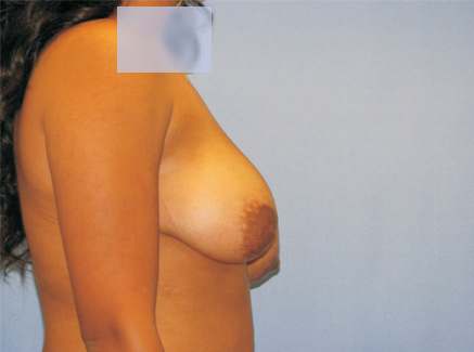 Photo of Patient 11 Before Breast Lift