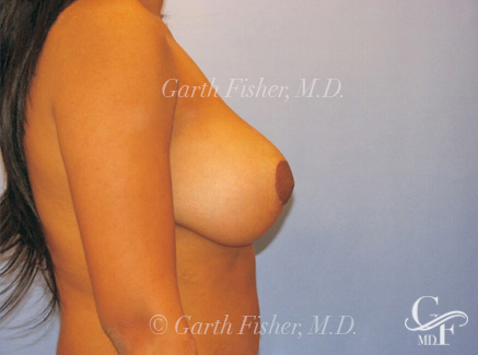 Photo of Patient 11 After Breast Lift