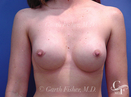 Photo of Patient 03 After Breast Revision