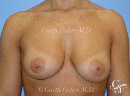 Photo of Patient 06 After Breast Revision