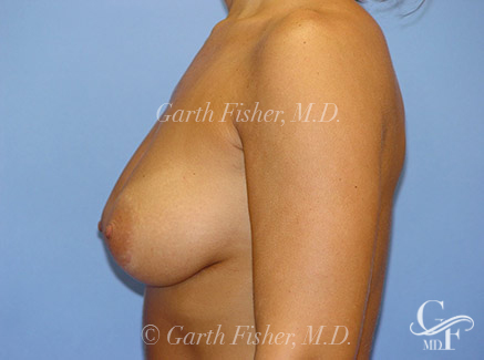 Photo of Patient 06 After Breast Revision