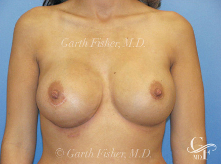 Photo of Patient 07 After Breast Revision