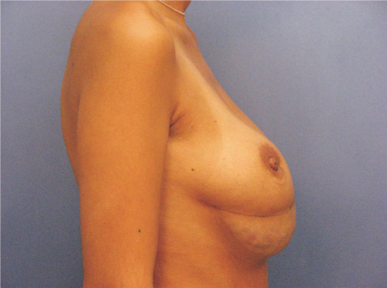 Photo of Patient 07 Before Breast Revision