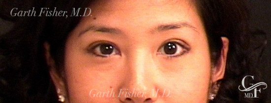 Photo of Patient 01 After Blepharoplasty