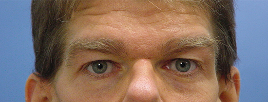 Photo of Patient 02 Before Blepharoplasty