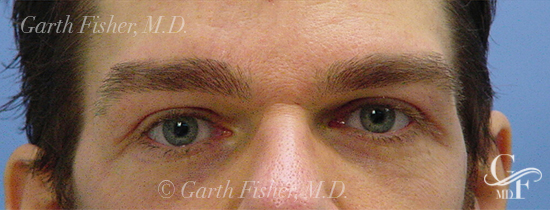 Photo of Patient 02 After Blepharoplasty