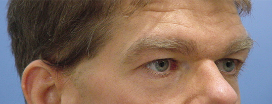 Photo of Patient 02 Before Blepharoplasty