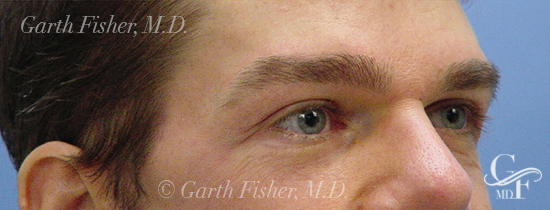 Photo of Patient 02 After Blepharoplasty