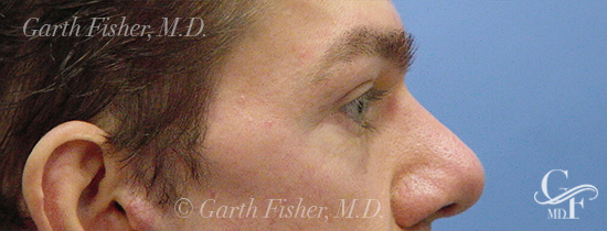 Photo of Patient 02 After Blepharoplasty