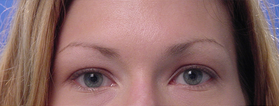 Photo of Patient 03 Before Blepharoplasty