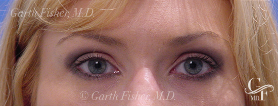 Photo of Patient 03 After Blepharoplasty