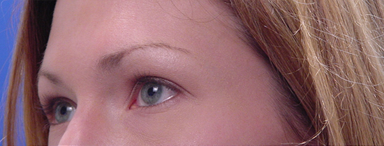 Photo of Patient 03 Before Blepharoplasty