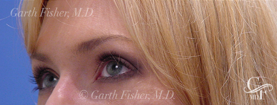 Photo of Patient 03 After Blepharoplasty