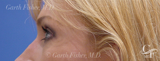 Photo of Patient 03 After Blepharoplasty